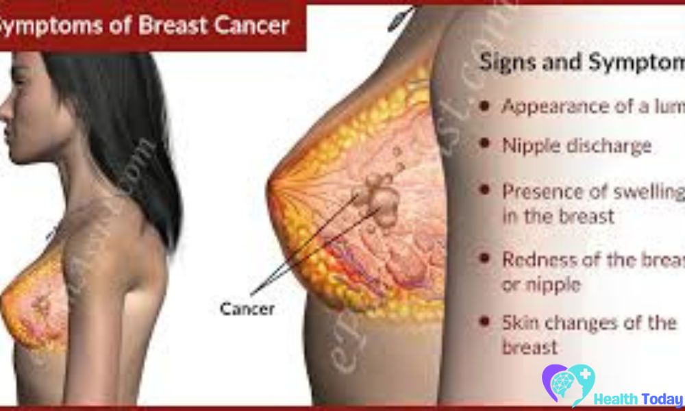 What are the Signs and Symptoms of Breast Cancer